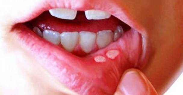 Ağız Yarası Oluşumunu Azaltmak İçin Vitamin Takviyesi Önemli