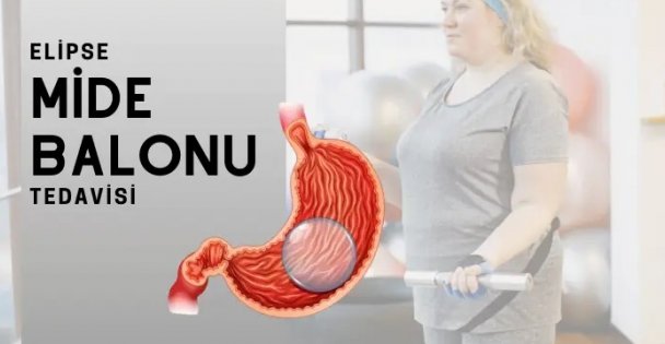 Allurion Mide Balonu