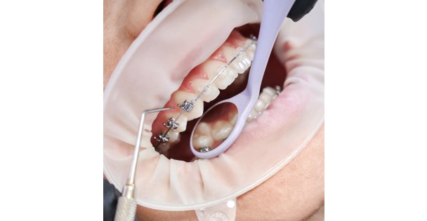 Diş Teli ile Mükemmel Gülüşlere Ulaşmanın Yolları