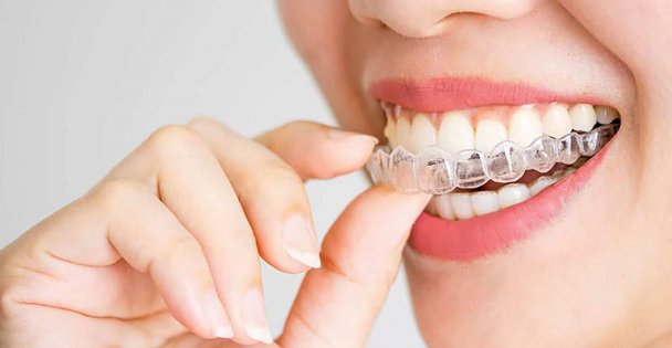 Şeffaf Plak Tedavisi (Invisalign) Hakkında Merak Edilenler