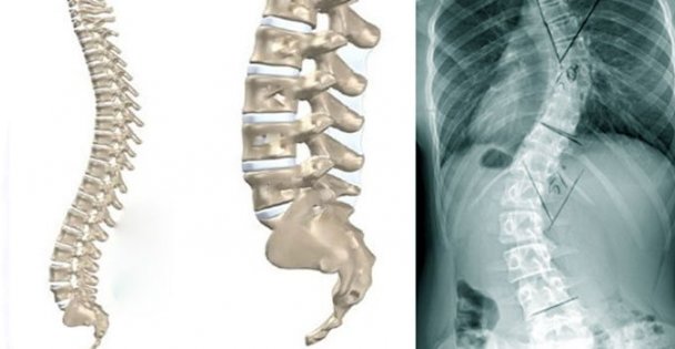 Skolyoz, Büyüme Çağında Şekil Bozukluğuna Yol Açabilir