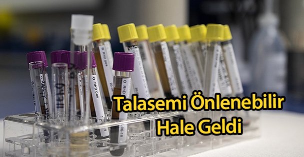 Talasemi Önlenebilir Hale Geldi