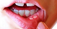Ağız Yarası Oluşumunu Azaltmak İçin Vitamin Takviyesi Önemli