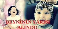 BEYNİNİN YARISI ALINDI!