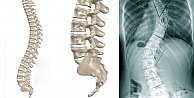 Skolyoz, Büyüme Çağında Şekil Bozukluğuna Yol Açabilir